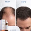 Minoxidil 5% Galenico 100 ml - Lozione Anticaduta
