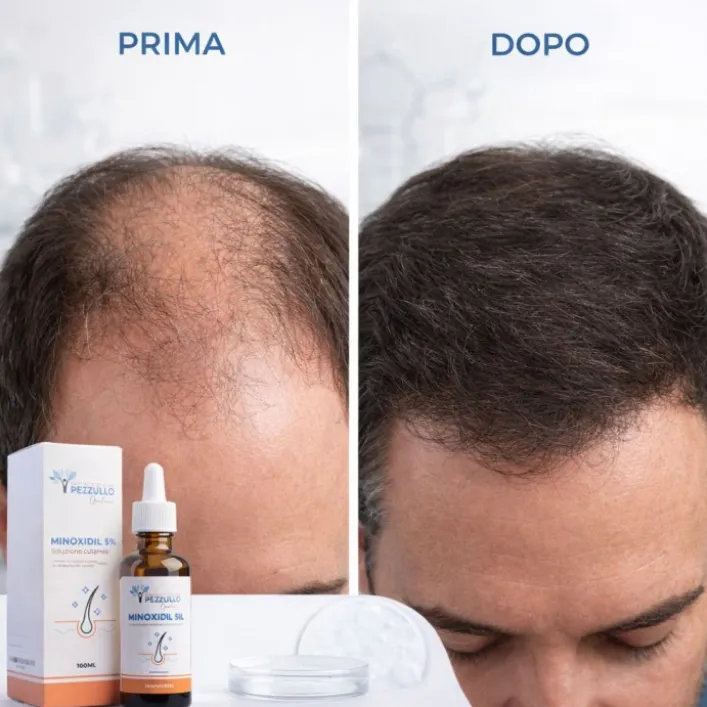 Minoxidil 5% Galenico 100 ml - Lozione Anticaduta